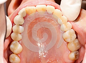 Metalo-ceramics vs. Pressed ceramics