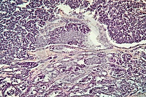 Metastases tumor diseased tissue photo