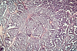 Metastases tumor diseased tissue photo