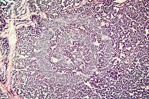 Metastases tumor diseased tissue photo