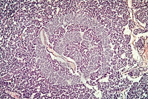 Metastases tumor diseased tissue photo