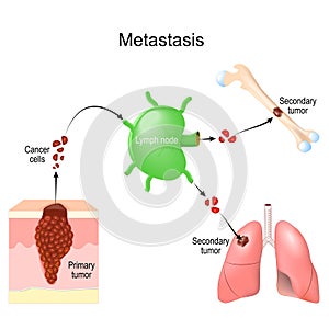 Metastasis. cancer invasion. malignant tumor