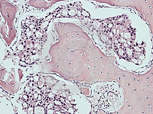 Metastasis of prostate cancer in bone marrow.