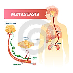 Metastasis vector illustration. Primary cancer and tumor labeled diagram. photo