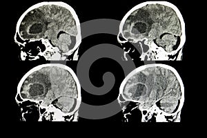 metastatic brain tumor