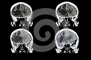 metastatic brain tumor