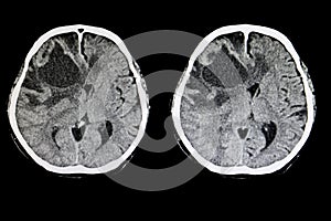 metastatic brain tumor photo