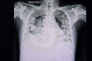metastatic carcinoma of the lungs photo