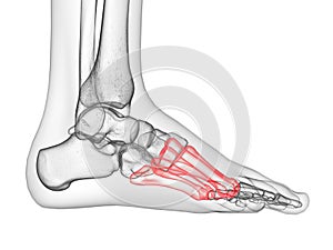 the metatarsal bone