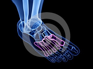 the metatarsal bones