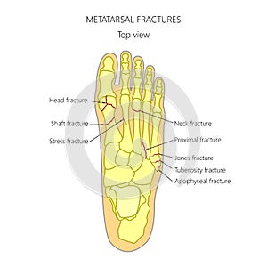 Metatarsal fractures photo