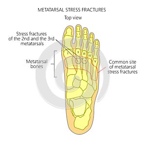 Metatarsal Stress fractures