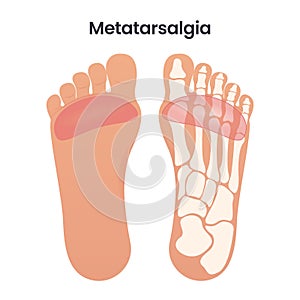 Metatarsalgia Pain in the Ball of the Foot medical educational vector illustration graphic photo