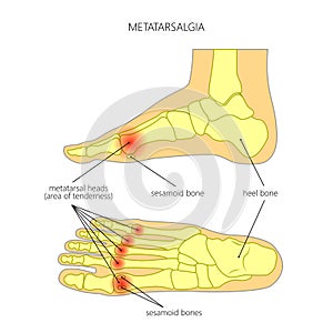 Metatarsalgia
