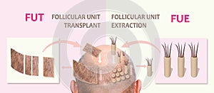 Methods of hair transplantation fut vs fue with infographic elements of illustration.
