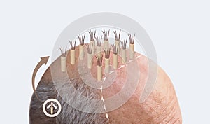Methods of hair transplantation fut vs fue with infographic elements of illustration.