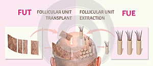 Methods of hair transplantation fut vs fue with infographic elements of illustration. photo