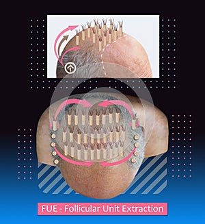 Methods of hair transplantation fut vs fue with infographic elements of illustration.