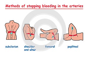 Methods of stopping bleeding in the arteries. info graphic