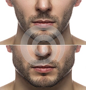 Mewing exercises. Result of a jawline reshape.
