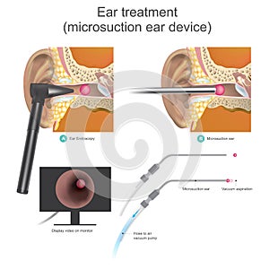 The Micro suction ear device it is vacuum working system.Doctor