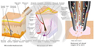 Microdermabrasion - Diamond Dermabrasion