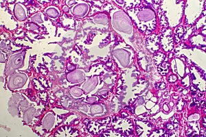 Micrograph of prostatic hyperplasia