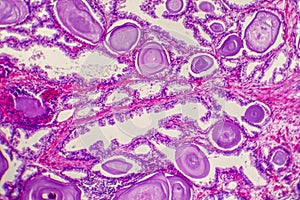 Micrograph of prostatic hyperplasia