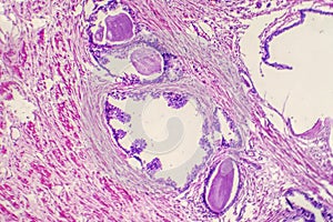 Micrograph of prostatic hyperplasia