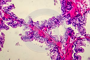 Micrograph of prostatic hyperplasia