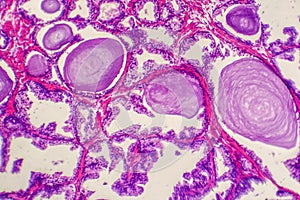 Micrograph of prostatic hyperplasia