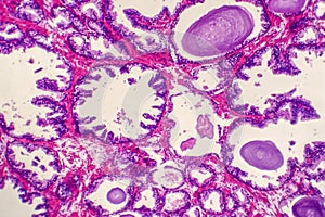 Micrograph of prostatic hyperplasia