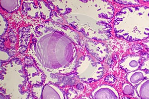 Micrograph of prostatic hyperplasia