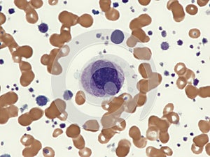 Micromegakaryocyte in peripheral blood.