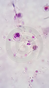 Microphotography show Spermatic inmature cell and white blood cell