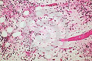 Microscope of Adenoid cystic carcinoma, rare type of cancer exist in many different body sites. This tumor occurs in the salivary