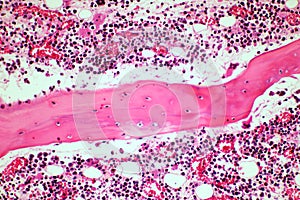 Microscope of Adenoid cystic carcinoma, rare type of cancer exist in many different body sites. This tumor occurs in the salivary