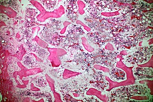 Microscope of Adenoid cystic carcinoma, rare type of cancer exist in many different body sites. This tumor occurs in the salivary