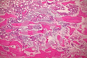 Microscope of Adenoid cystic carcinoma, rare type of cancer exist in many different body sites. This tumor occurs in the salivary