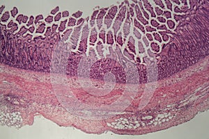 Microscope photo of a large intestine section with inflammation Colitis photo