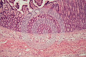 Microscope photo of a large intestine section with inflammation Colitis