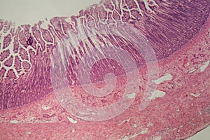 Microscope photo of a large intestine section with inflammation Colitis