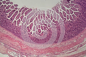 Microscope photo of a large intestine section with inflammation Colitis