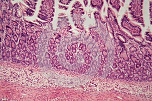 Microscope photo of a large intestine section with inflammation Colitis