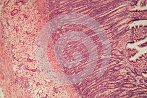 Microscope photo of a large intestine section with inflammation Colitis