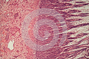 Microscope photo of a large intestine section with inflammation Colitis