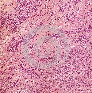 Microscope picture of benign nerve tumour