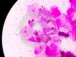 Microscopic close view of high vaginal swab Bacterial vaginosis (BV).