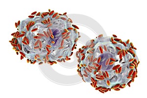 Microscopic diagnosis of bacterial vaginosis. Epithelial cell, so-called clue cell is covered with bacteria Gardnerella photo