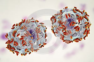 Microscopic diagnosis of bacterial vaginosis. Epithelial cell, so-called clue cell is covered with bacteria Gardnerella photo